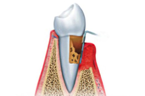 soins dentaires Soumoulou La parodontologie